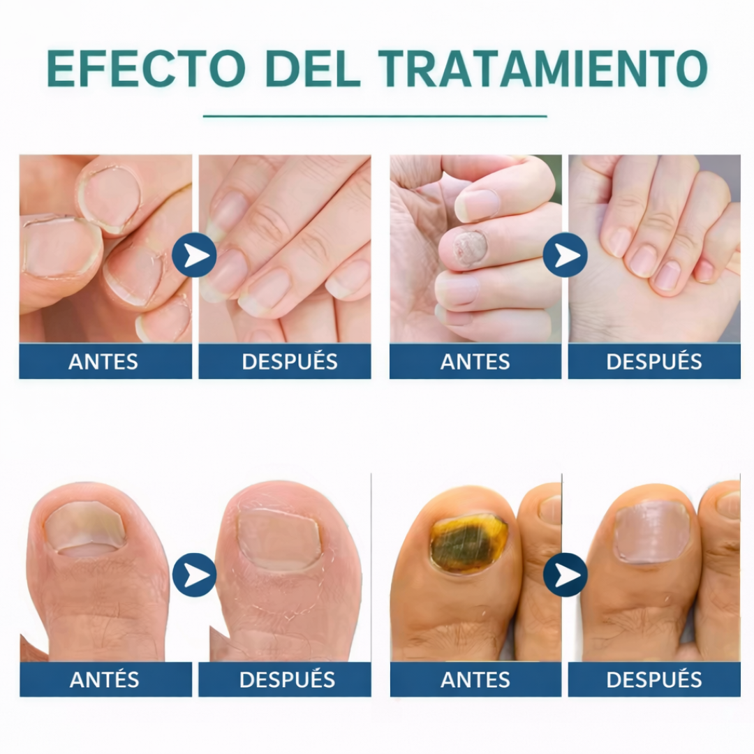 Parches Antihongos para Uñas – Reparación Intensiva y Renovación Visible