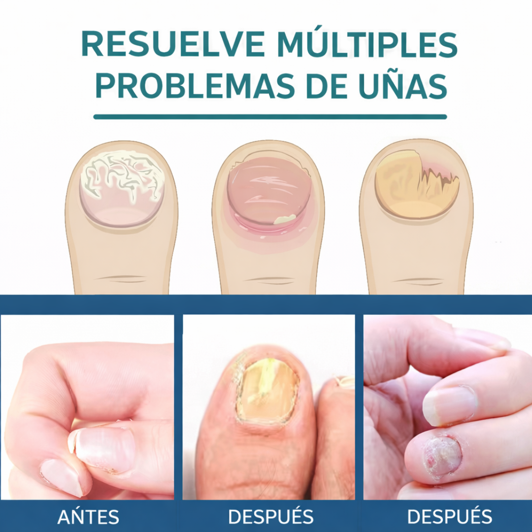 Parches Antihongos para Uñas – Reparación Intensiva y Renovación Visible